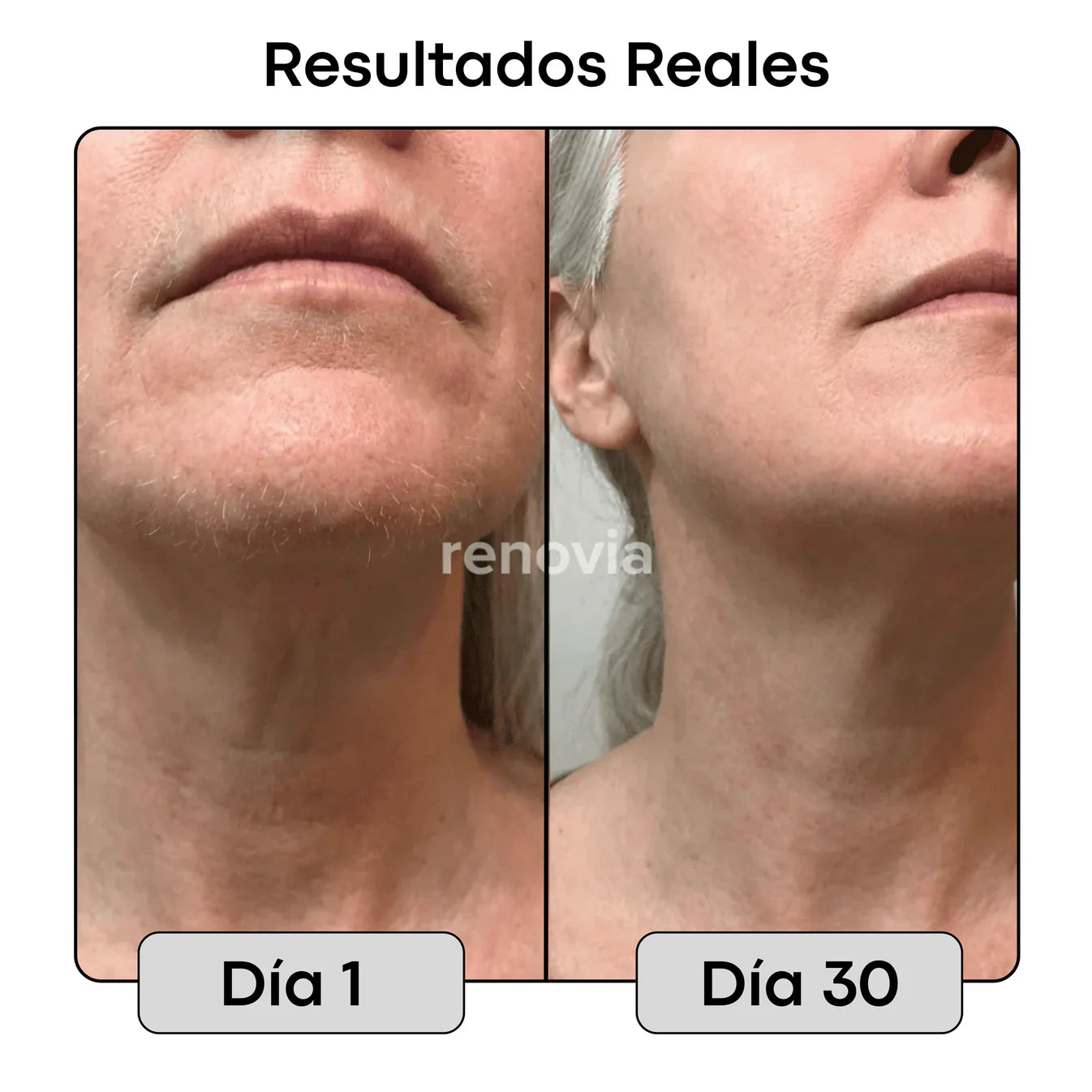 2x1 Cyperus Rotundus Renovia™ | Detén el crecimiento del vello no deseado de forma natural