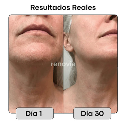 2x1 Cyperus Rotundus Renovia™ | Detén el crecimiento del vello no deseado de forma natural