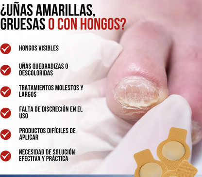 HongoBye – ¡Despídete del hongo para siempre! uñas.  30x1